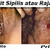 Obat Sipilis Paling Mujarab thumbnail