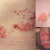 Gejala Penyakit Herpes di Mulut thumbnail
