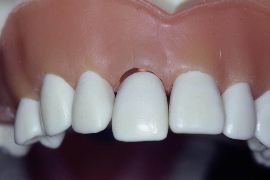 Dentistry Custom Cast Dowel Core