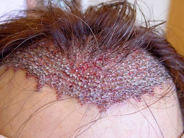 Hair plugs trypophobia Hair plugs trypophobia can believe