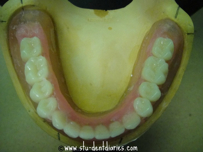 StuDENT Diaries Removable Prosthodontics Complete Dentures