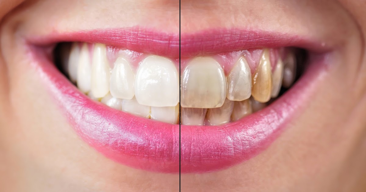 Ask a dentist about how to get stains out of your teeth Brenham