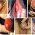 Gonore Bisa Menyebabkan Wanita Mandul thumbnail