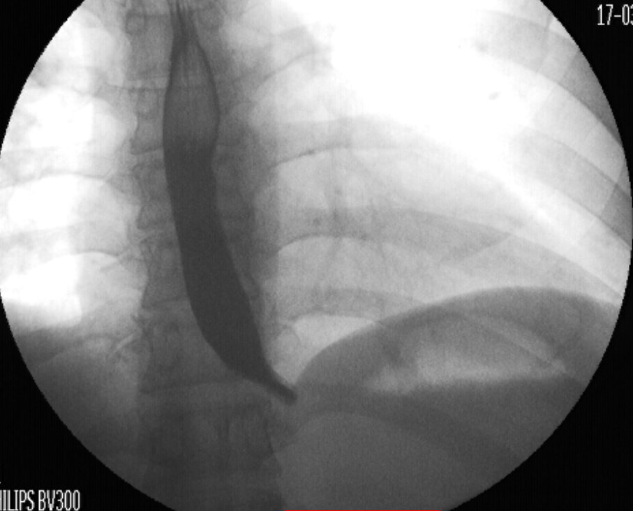 "Normal" Lap Band placement! DSSurgery