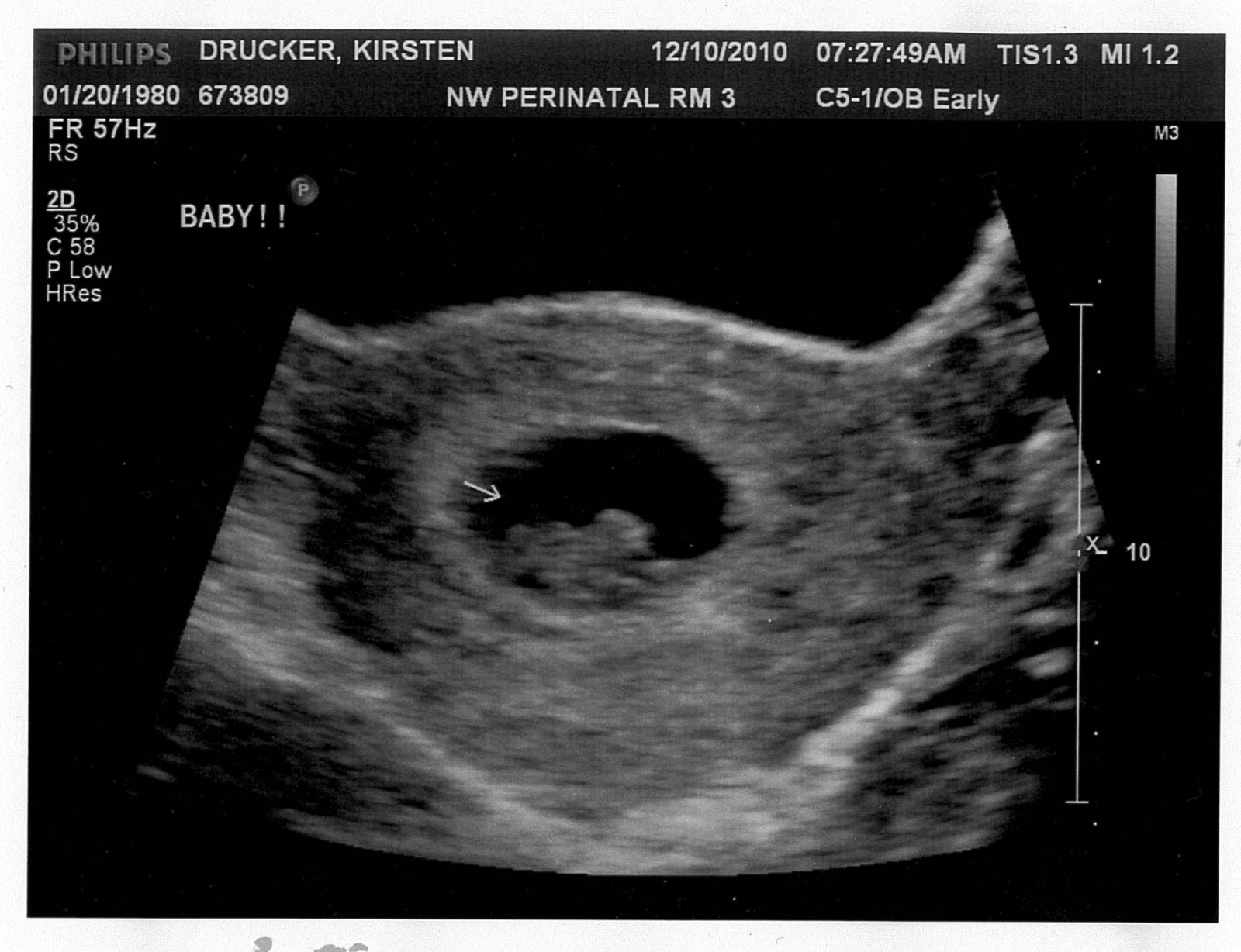 Ultrasound 8 Weeks