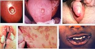 sipilis sipilis