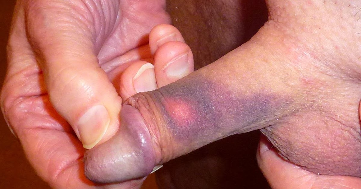 Agree, remarkable girl bruised by dick pic can Girl bruised by dick pic well