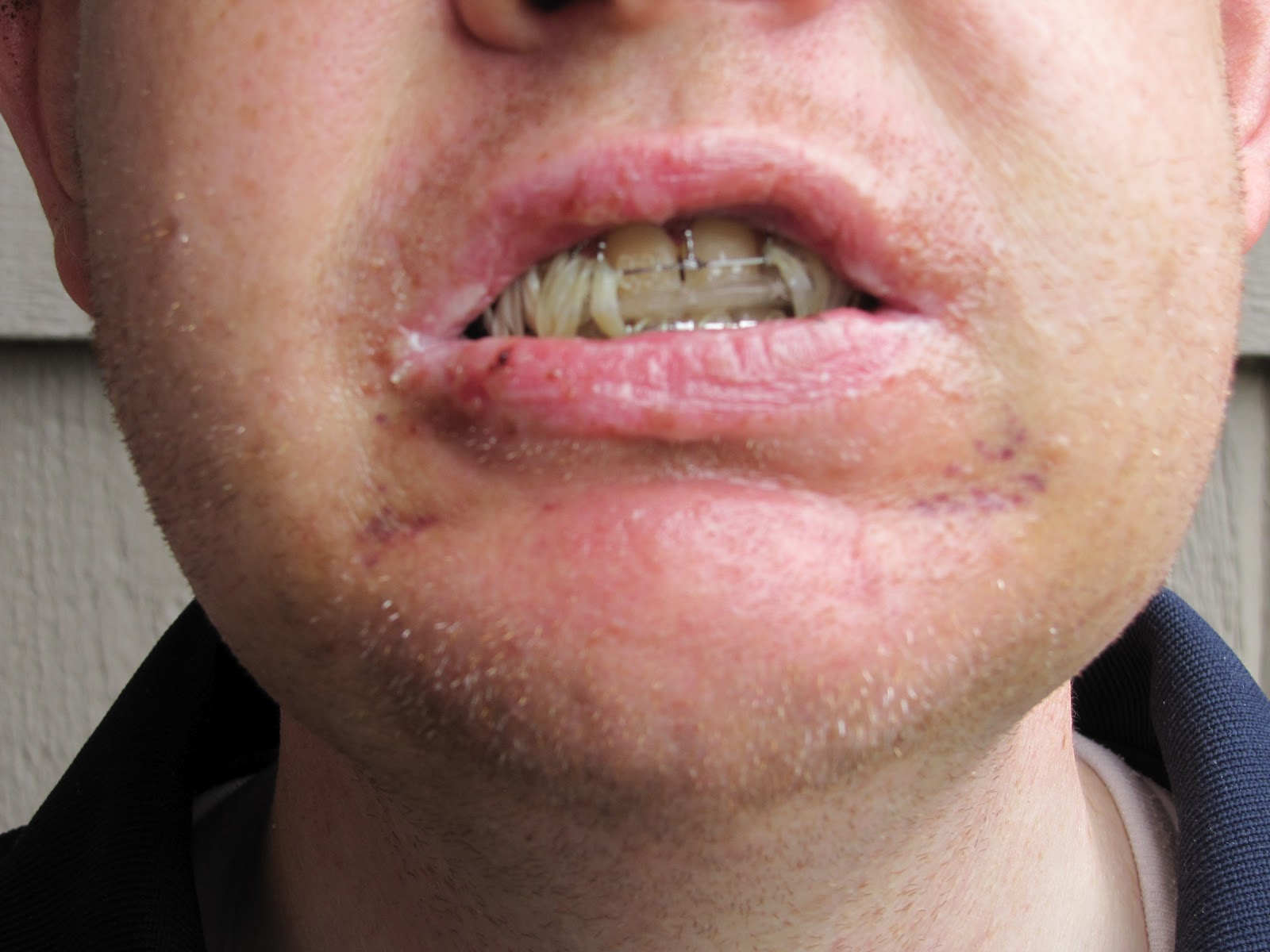 Double Jaw Operation The Road to Recovery