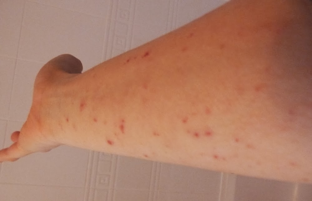 I Have Eczema: December Skin: Day 205 TSW
