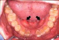 tori and teeth