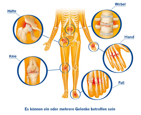 Voltaren diclofenaco sodico) | bulasmed