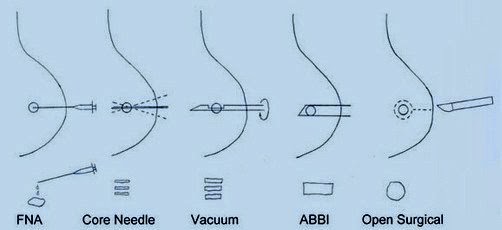 Biopsy of Breast Cancer Biopsy of Breast Cancer