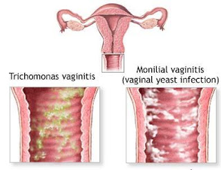 cara menyembuhkan keputihan pada wanita cara menyembuhkan keputihan pada wanita