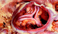 CALCIFIC AORTIC VALVE CALCIFIC AORTIC VALVE
