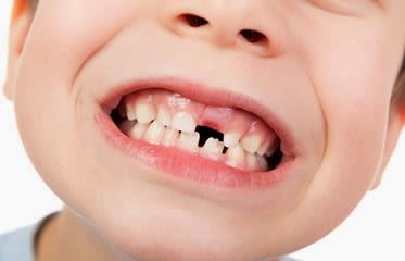 What to do when a tooth falls out?