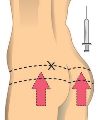 IMPLANTE GLUTEOS implante gluteos: