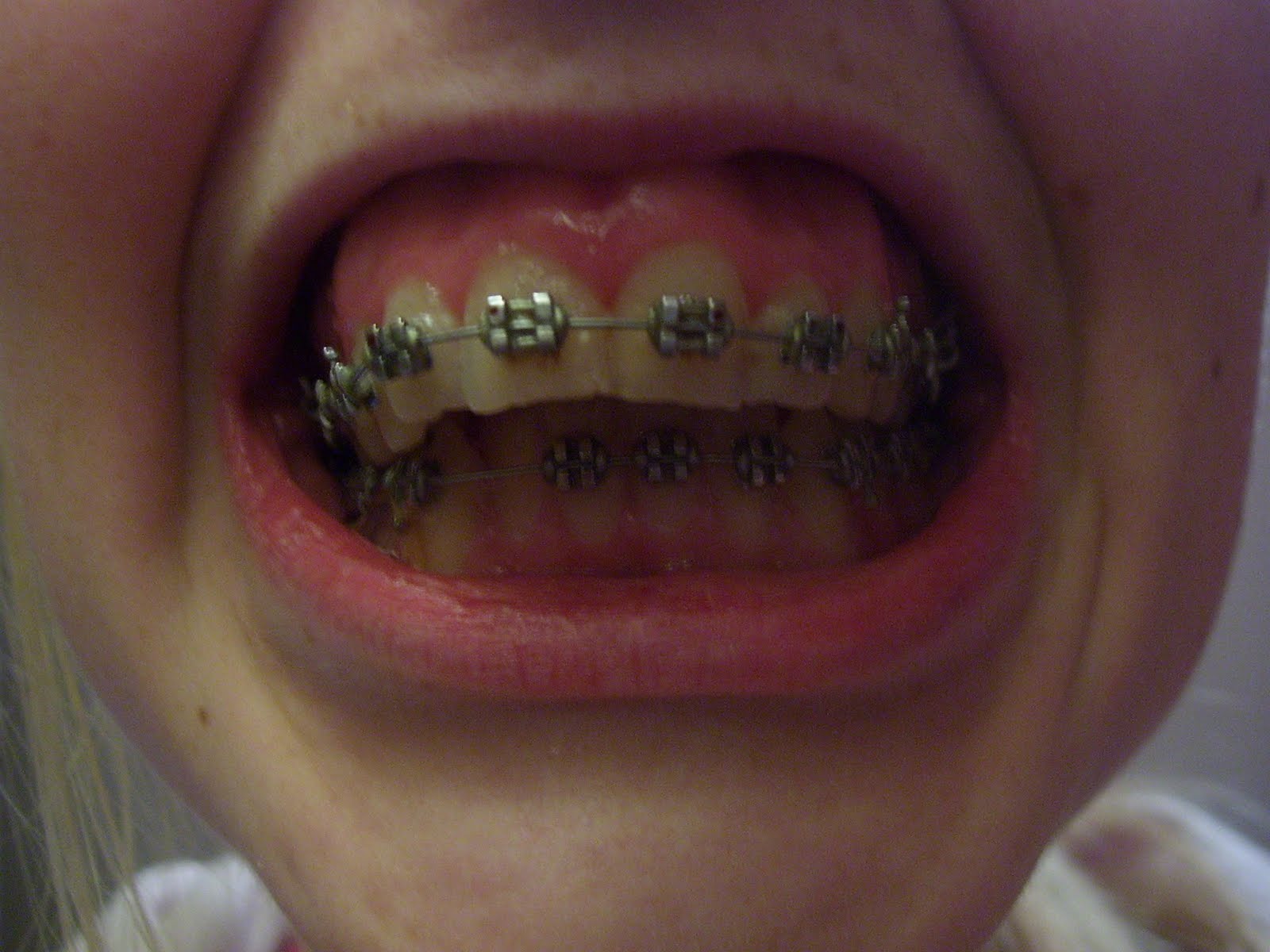 My Jaw Surgery Story 2 weeks of braces