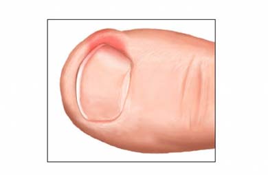 Los nuevos medios del tratamiento del hongo de las uñas en los pies