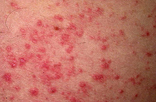 Atopic dermatitis.2