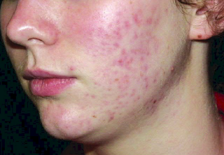 Bad acne and how to handle Bad acne and how to handle