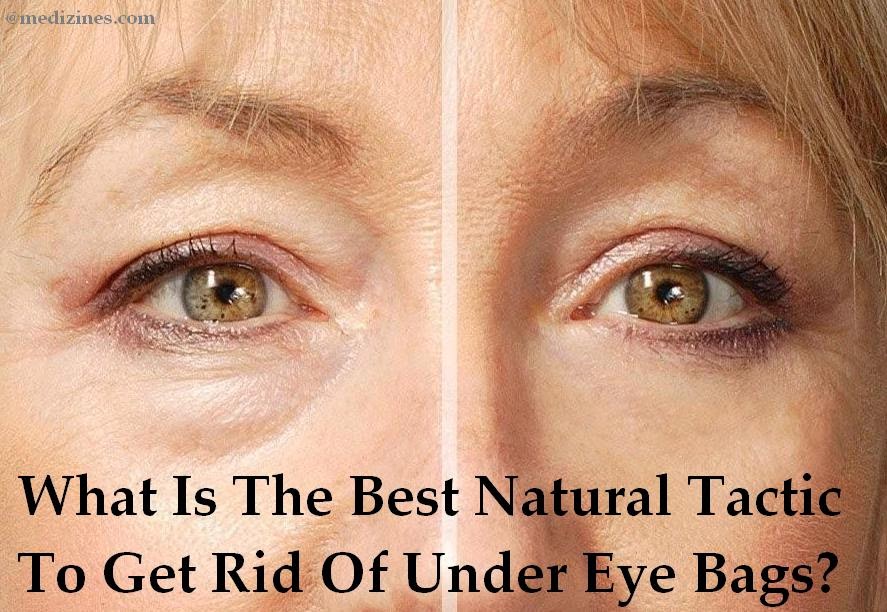 What Is The Best Natural Tactic To Get Rid Of Under Eye Bags?