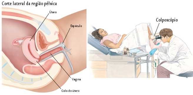 Lavoisier - 💁🏽‍♀️ A Colposcopia é um exame ginecológico