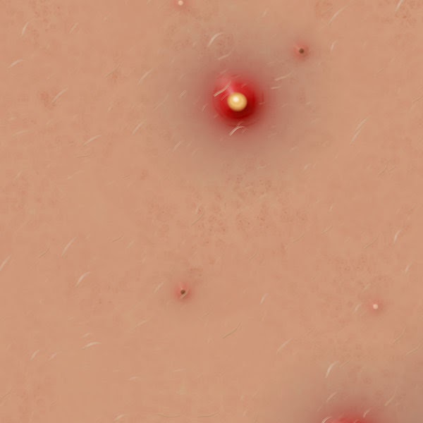 Acne Treatment : Treat Acne With Essential Fatty Acids Acne Treatment : Treat Acne With Essential Fatty Acids