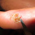 What to Consider Before Trying to Remove Your Own Warts