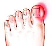ingrown toenail