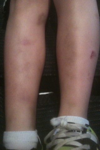 Bumps On Shin