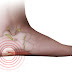 Heel Spur Orthotics Offer Heel Spurs Relief