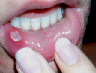 små vita blåsor på tungan