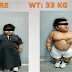 morbidly obese 2-year-old with life-threatening BMI undergo weight loss surgery thumbnail