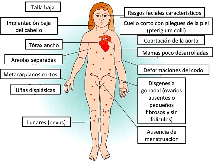 rett syndrome a rare incurable disorder essay rett syndrome a rare incurable disorder essay