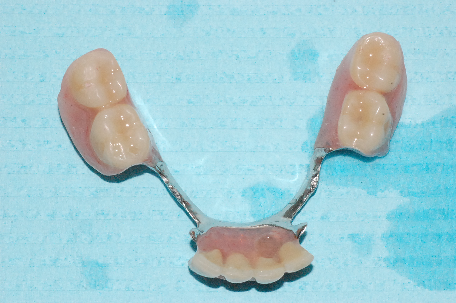 Westlake Dental Center, LTD Locators supported lower partial denture