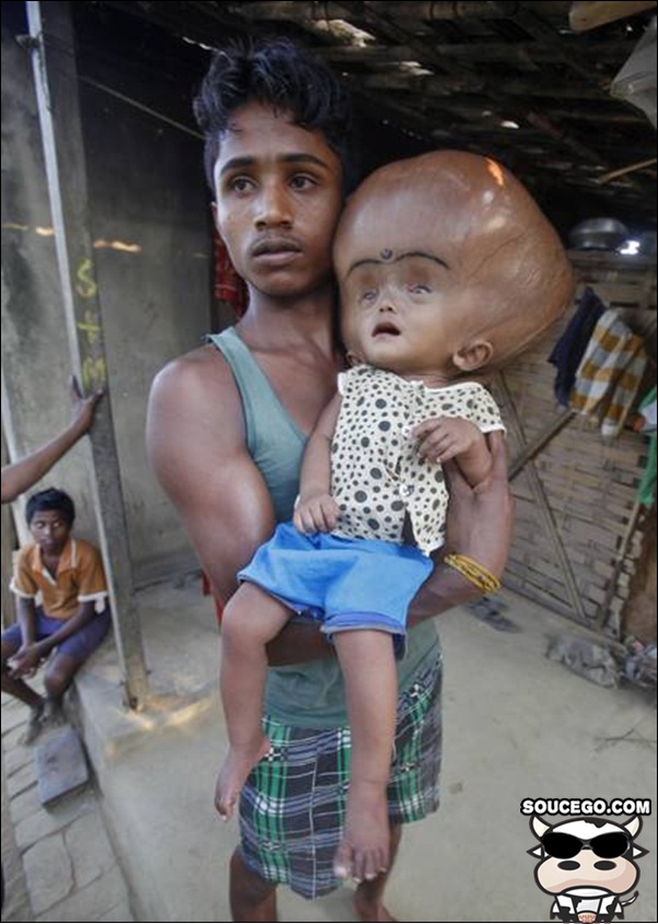 Criança indiana com doença rara tem a cabeça gigante Fuxico Da Rede