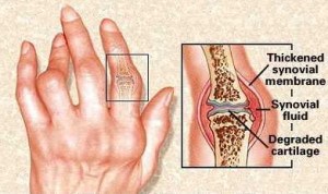 Cara Mengobati Benjolan Asam Urat Di Tangan Cara Mengobati Benjolan Asam Urat Di Tangan
