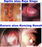 penyakit sipilis raja singa kencing nanah gonore penyakit sipilis raja singa kencing nanah gonore
