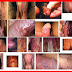 Obat Bintik Merah Pada Bibir Vagina thumbnail