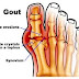Tanda Dan Gejala Gout Arthritis ( Asam Urat ) - Kenali Obatnya thumbnail
