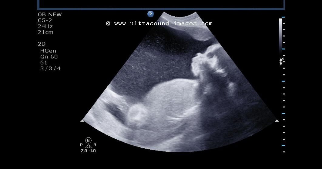 low amniotic fluid at 38 weeks low amniotic fluid at 38 weeks