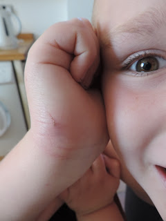 injury sustained on scout cub camp