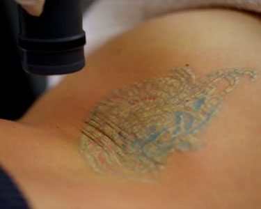 laser tattoo removal in daegu 韩国大邱心跳皮肤科医院 laser tattoo removal in daegu 韩国大邱心跳皮肤科医院