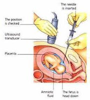 PRENATAL DIAGNOSIS PRENATAL DIAGNOSIS