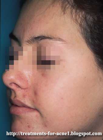 Acne Treatments, Cure Acne Treatment: Do You Know Which Is The Best Acne Treatment For You?