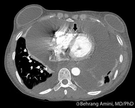 ct chest cardiac tamponade