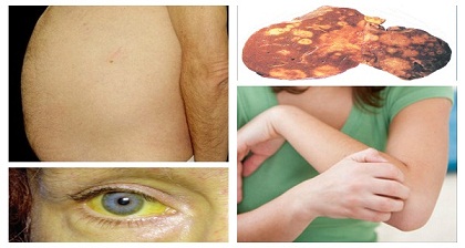 Los síntomas de cáncer de hígado que usted debe Nunca haga caso y lo que puede hacer para reducir su riesgo. Los-síntomas-de-cáncer-de-hígado-que-usted-debe-Nunca-haga-caso-y-lo-que-puede-hacer-para-reducir-su-riesgo.