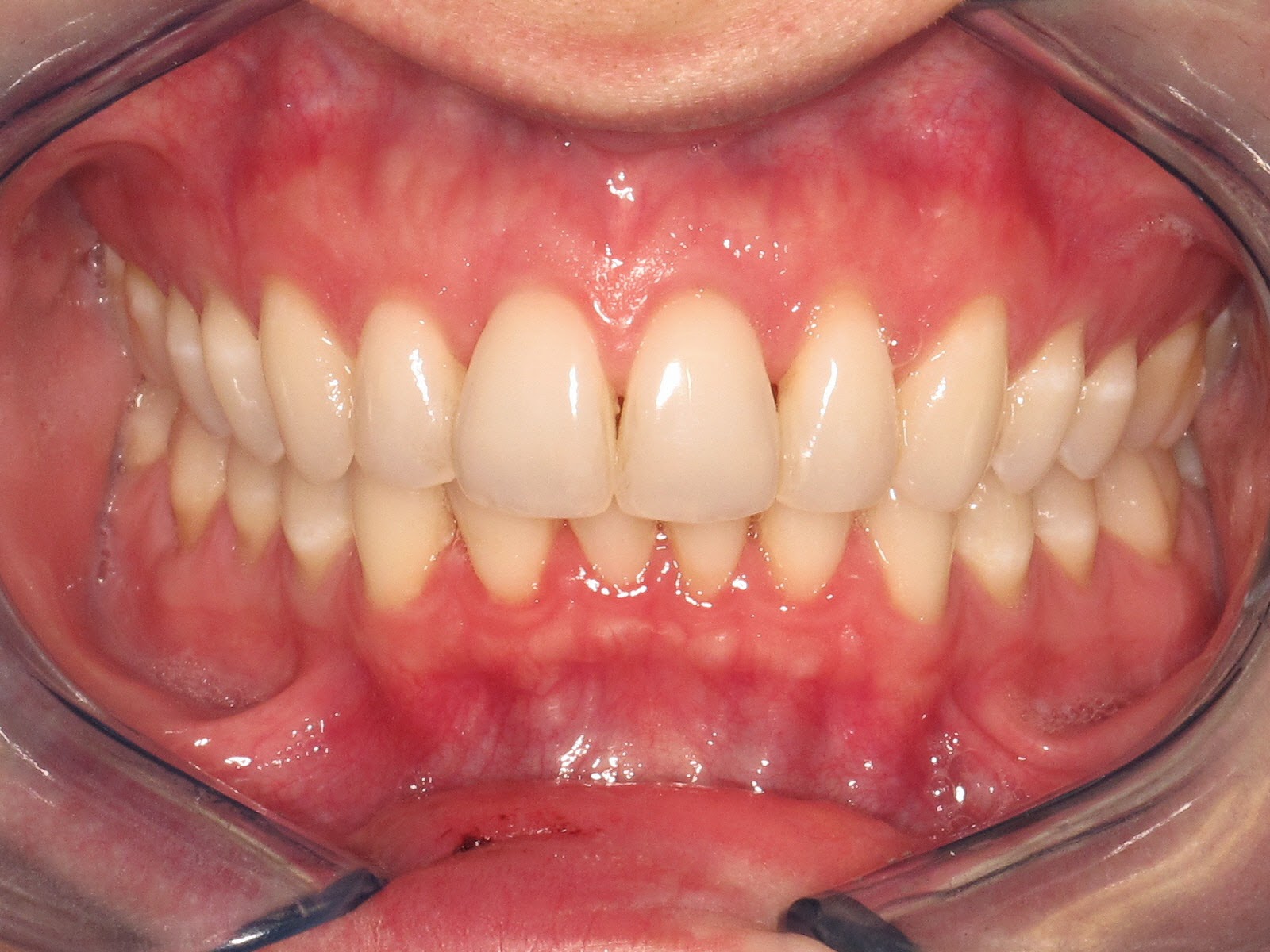 Orthodontist Dr. Judith A. Okun Westchester and Rye Brook, NY "Invisalign" Retainers forever