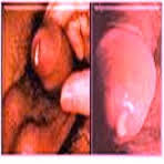 Cara Cepat Menyembuhkan Penyakit Gonorrhea Cara Cepat Menyembuhkan Penyakit Gonorrhea