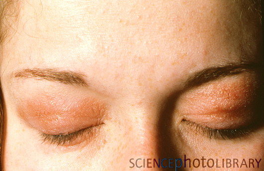 Allergic Reaction To Drinking Water Allergic Reaction To Drinking Water